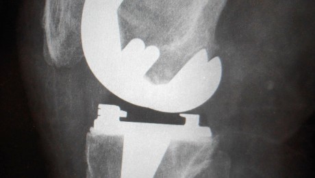 Röntgen Knie TEP seitlich nach OP